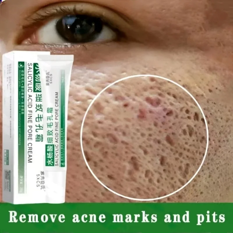 Salicylic Acid Blackhead Remover - Crema limpiadora de poros de ácido